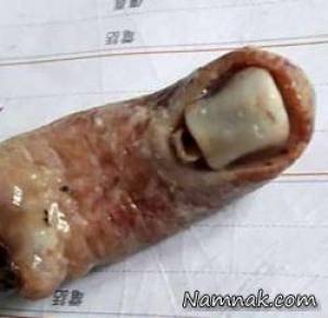 انگشت بریده