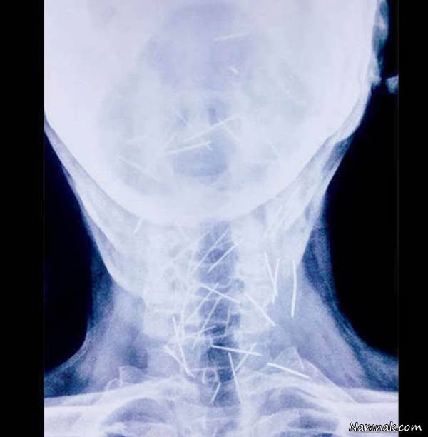 سوزن داخل بدن سوزن بدن