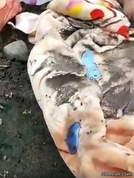 دختر فلج مغزی