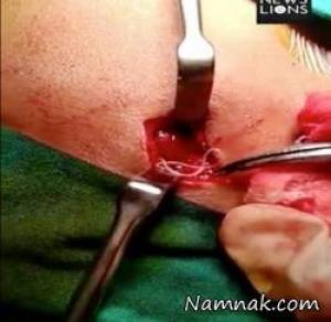 کرم زنده داخل صورت