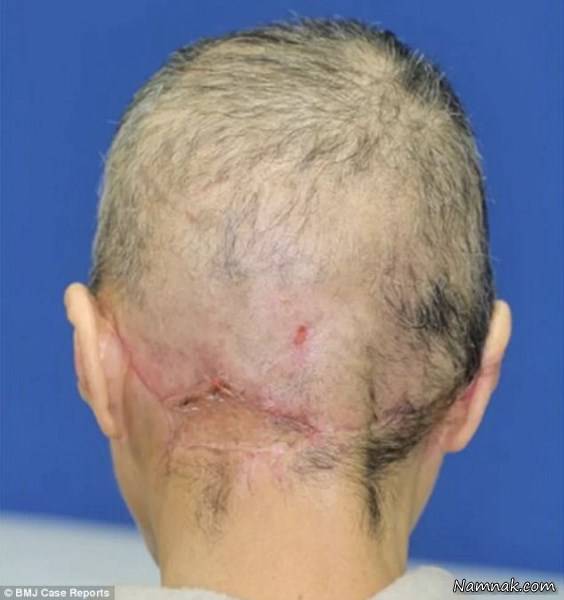 کنده شدن پوست سر