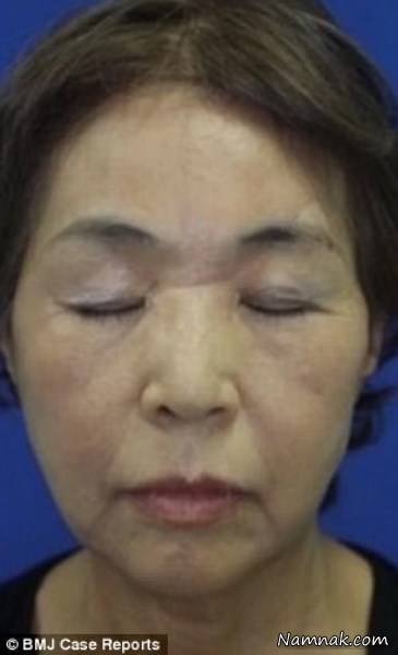 کنده شدن پوست سر