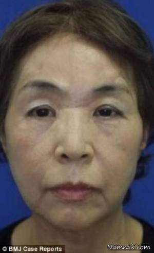 کنده شدن پوست سر