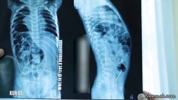 سوزن داخل شکم کودک خردسال