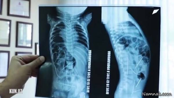 فرو کردن سوزن داخل سینه کودک