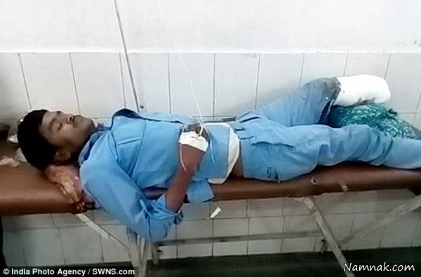 پای قطع شده