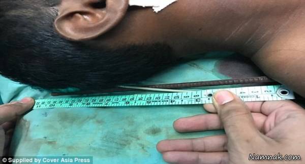 فرو رفتن میلگرد در گردن کارگر فرو رفتن میلگرد در گردن کارگر