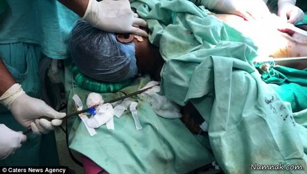 فرو رفتن میلگرد در گردن کارگر فرو رفتن میلگرد در گردن کارگر