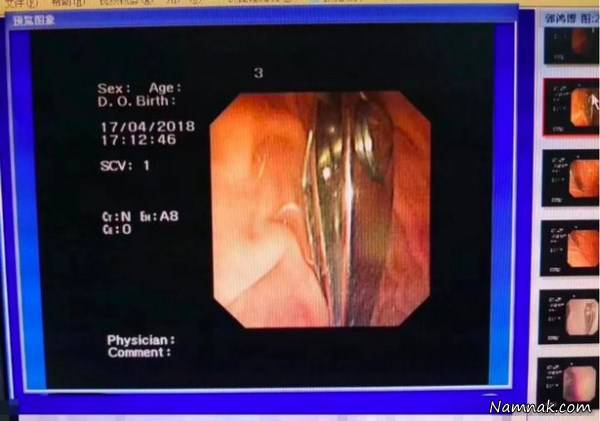 قورت دادن ناخن گیر